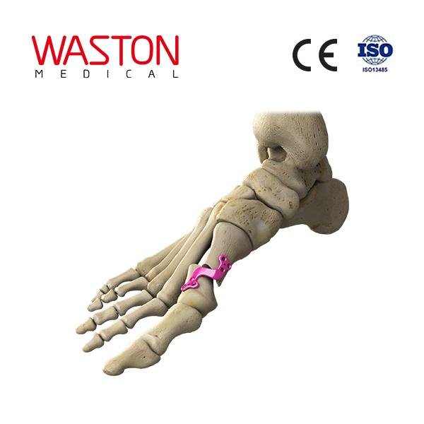 第一跖骨远端接截骨钢板 骨科 植入物 足部 矫正器械 链接 截骨术     