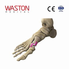 第一蹠骨遠端接截骨鋼板 骨科 植入物 足部 矯正器械 鏈接 截骨朮     