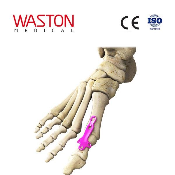 跖趾关节融合板Ⅰ型  骨科 植入物 足部 矫正器械 链接 截骨术     