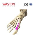 跖趾关节融合板Ⅰ型  骨科 植入物 足部 矫正器械 链接 截骨术      1
