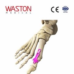 Implants Foot Orthoses Orthopaedics CE Metatarsophalangeal joint fusion plate I 