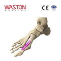 Implants Foot Orthoses Orthopaedics CE Metatarsophalangeal joint fusion plate II  1