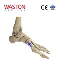 Implants Foot Orthoses Joints Orthopaedics CE Hollow metatarsal osteotomy plate 