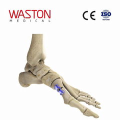 Implants Foot Orthoses Joints Orthopaedics CE Hollow metatarsal osteotomy plate 