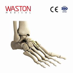 跖楔關節背側板 骨科 植入物 足部 矯正器械 鏈接 截骨朮