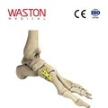 Foot Orthoses Osteotomy CE The first metatarsal cuneiform joint medial plate 