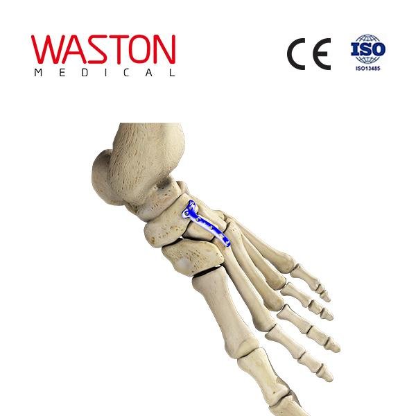 跨舟楔第二跖楔关节背侧板 骨科 植入物 足部 矫正器械 链接 截骨术    