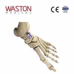 Implants Foot Orthoses Joints Osteotomy CE Talonavicular joint fusion plate 