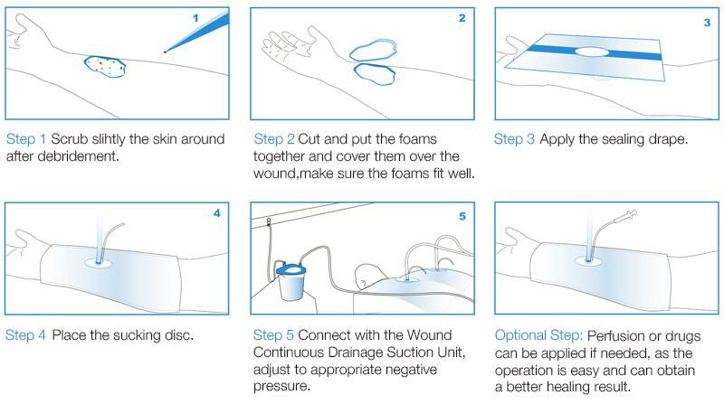 一次性负压引流套件 海王星1号 伤口 创伤 白海绵 薄膜 2