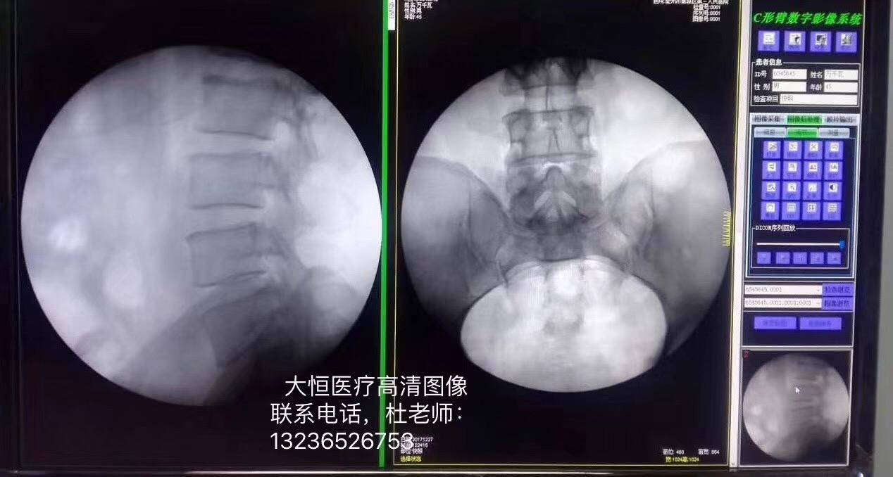 移动式C型臂X射线机