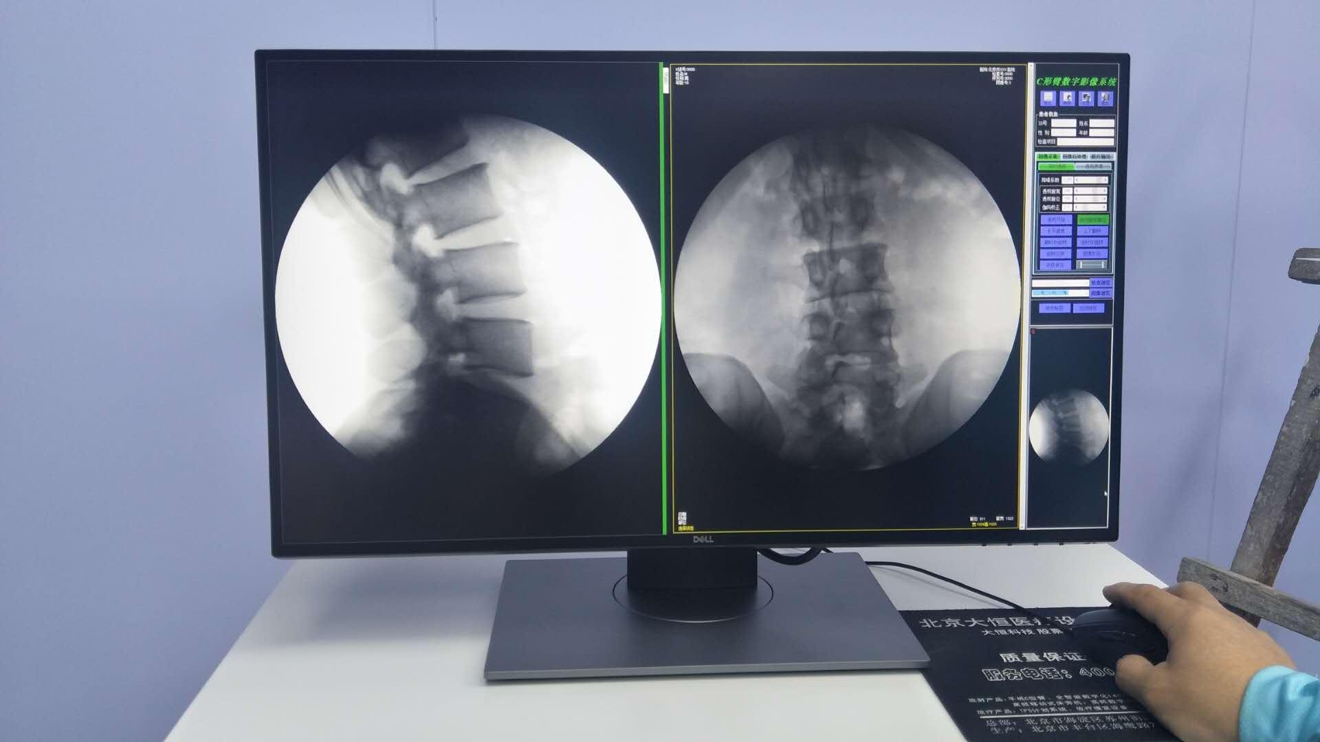 移动式C型臂X射线机 3