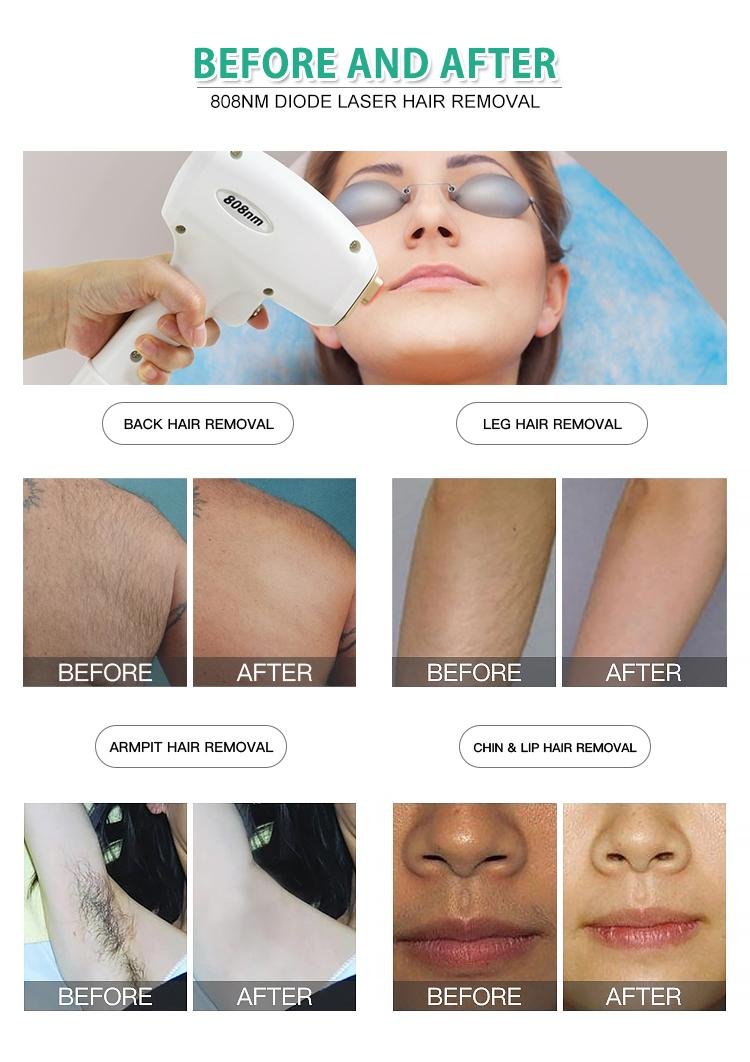 808nm diode laser beauty machine for hair removal  5