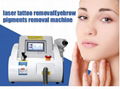 nd yag q switched laser tattoo removal