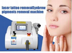 nd yag q switched laser tattoo removal