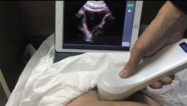   BProbe-2四維掃描無線探頭式膀胱儀 4
