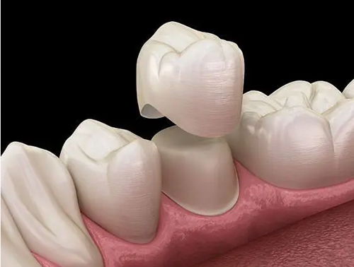 Dental lab Zirconia porcelain denture