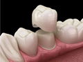 Dental lab Zirconia porcelain denture