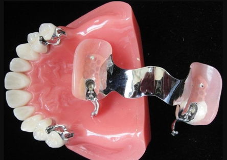 Dental Treatment Dental Metal Ceramic Crown Made  Dental Lab in  2