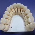 Factory Price Dental Cobalt Chrome Casting Framework Denture 1