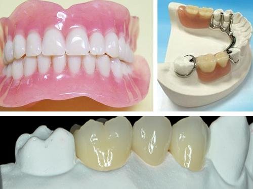 Factory Price Dental Cobalt Chrome Casting Framework Denture 3