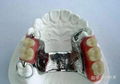 3d printed occlusal splint - Orthodontic Clear Aligner 1