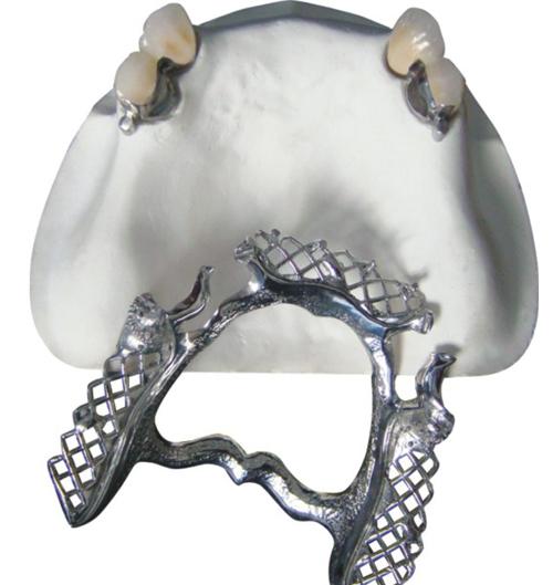 3d printed occlusal splint - Orthodontic Clear Aligner 2