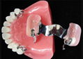 3d printed occlusal splint - Orthodontic Clear Aligner 3
