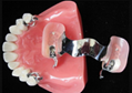 3d printed occlusal splint - Orthodontic Clear Aligner