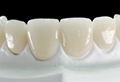Braces For Overbite - Dental orthodontic braces 1
