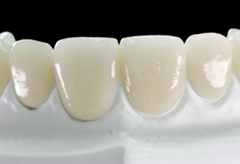 Braces For Overbite - Dental orthodontic braces