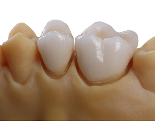 Braces For Overbite - Dental orthodontic braces 2