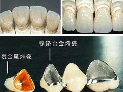 Porcelain Fused to Metal Lab from China