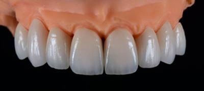 Zirconia Dental Crown | Zirconia Dental Lab in 4