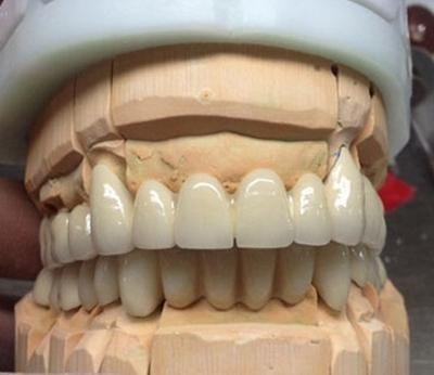 Porcelain-Fused-to-Metal (PFM) Crowns - China Dental Lab 2