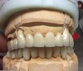 Porcelain-Fused-to-Metal (PFM) Crowns - China Dental Lab 2