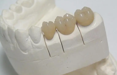 Porcelain-Fused-to-Metal (PFM) Crowns - China Dental Lab 3