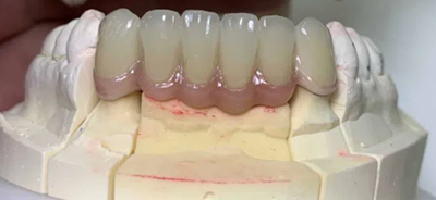 Porcelain-Fused-to-Metal (PFM) Crowns - China Dental Lab 4