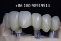 Invisible Orthodontic Mouth Guard From