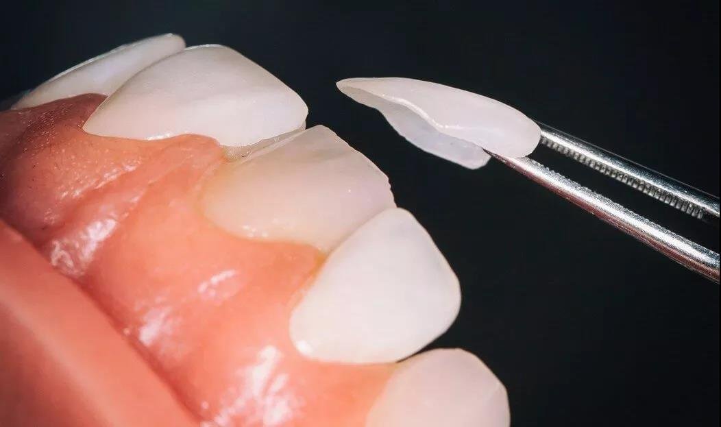 牙齿贴片国产玻璃陶瓷牙齿美白贴片仿真牙齿贴片可定制