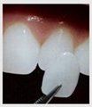 牙齿贴片可定制牙齿全瓷贴片铸瓷仿真贴片 5