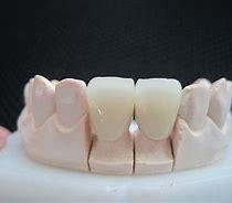 可定制仿真牙齿贴片超薄美白全瓷贴片顶级西诺德全瓷 2
