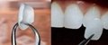 牙齒貼片國產愛爾創玻璃陶瓷牙齒超薄美白仿真牙齒貼片可定製