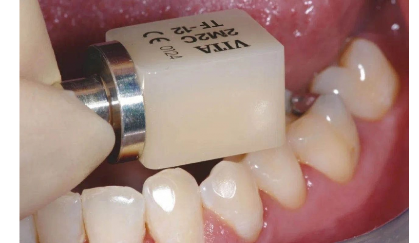 进口VITA瓷立方可定制超薄美白全瓷贴片仿真牙齿贴片 4
