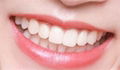 进口VITA瓷立方可定制超薄美白全瓷贴片仿真牙齿贴片 5