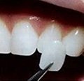 牙齒貼片牙齒美白貼片仿真牙齒貼片國產玻璃陶瓷可定製 2