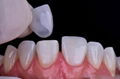 牙齒貼片牙齒美白貼片仿真牙齒貼片國產玻璃陶瓷可定製 3