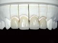超薄美白全瓷贴片可定制仿真牙齿贴片顶级西诺德全瓷 4