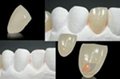 牙齿贴片全瓷进口VITA琥珀瓷牙齿全瓷贴片仿真定制 3