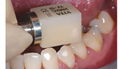 仿真牙齒貼片進口VITA瓷立方可定製超薄美白全瓷貼片 1