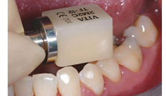 仿真牙齒貼片進口VITA瓷立方可定製超薄美白全瓷貼片
